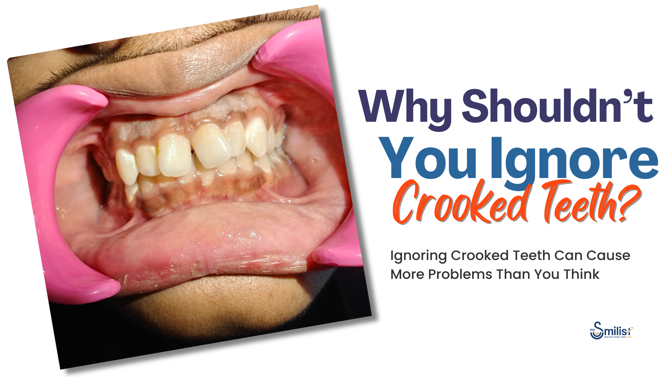 Feature image crowded and crooked teeth before treatment with dental alignment concerns